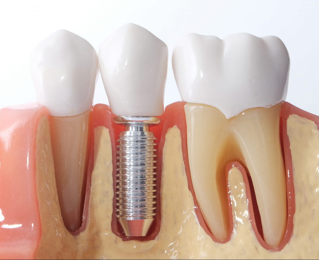 Implantes-dentales-pic-1-e1560352273323_1-1024x836.jpg